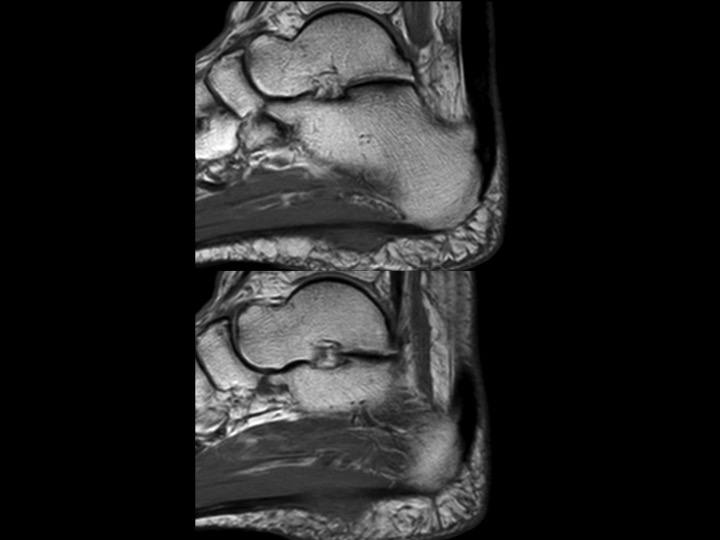 Figure 2 for case central bundle of plantar fascia ( RID3231 )